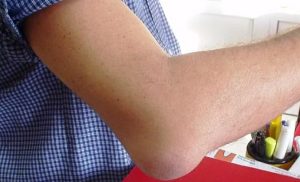 Бурсит ліктьового суглоба – біль при згинанні та розгинанні руки, локальний набряк та підвищення температури можуть сигналізувати про бурсит. При пошкодженні суглоба клітини синовіальної оболонки активно виділяють рідину, що накопичується всередині суглобової сумки. В результаті на зовнішній стороні ліктя зазвичай утворюється характерна шишка або набряк, а процес її збільшення супроводжується болючістю, локальним підвищенням температури та почервонінням шкіри. Для гострого бурситу характерний сильний больовий синдром та обмеження обсягу рухів. При хронічній формі відчувається помірне печіння, лікоть здається ущільненим. У ряді випадків бурсит призводить до ускладнень – гнійного процесу. Для визначення конкретного типу захворювання може бути призначена пункція.