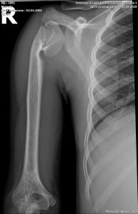 Корекційна остеотомія невірно консолідованого перелому плечової кістки