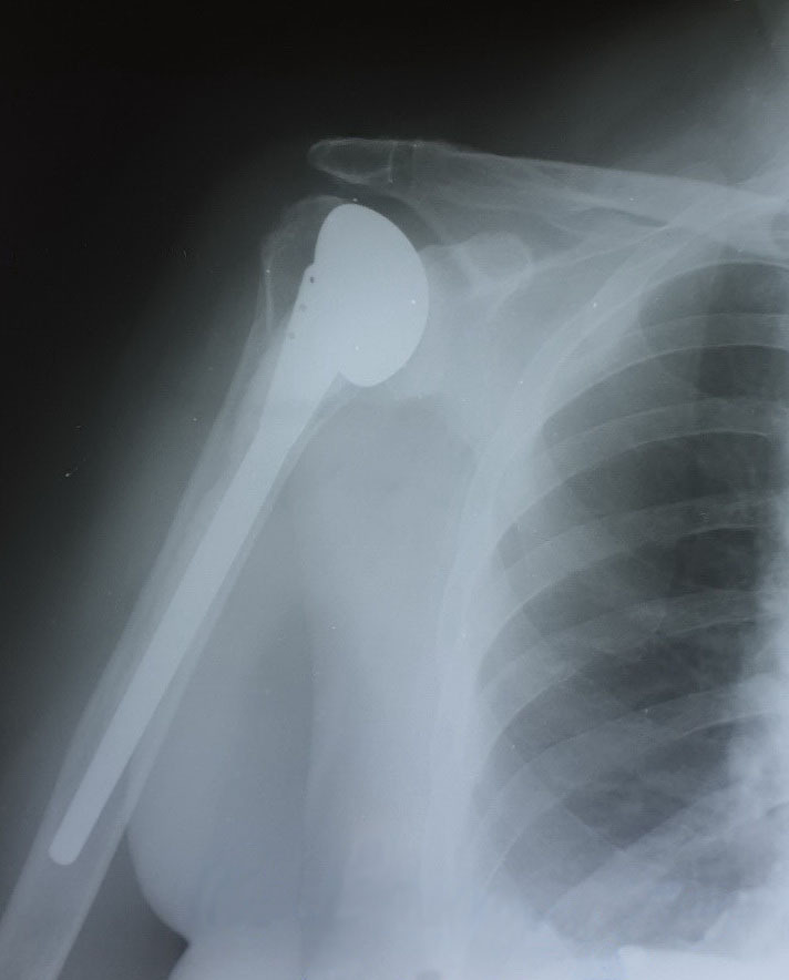 Рис. 2. Рентгенограма правого плечового суглоба: стан після однополюсного ендопротезування плечового суглоба