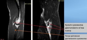 Візуальні ознаки пошкодження дистального сухожилку двоголового м'яза плеча​