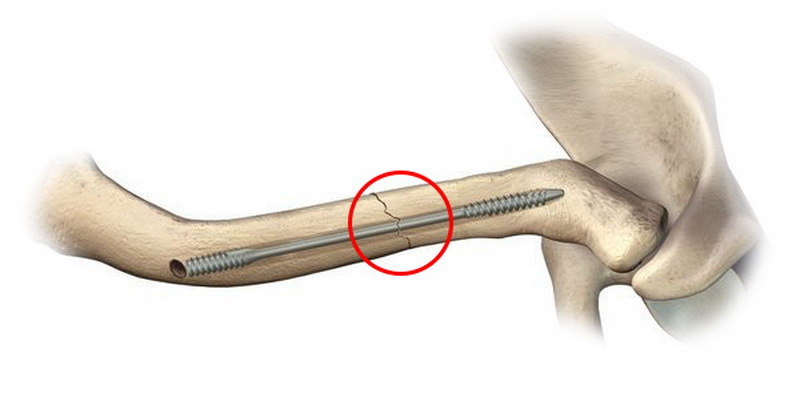 Канюльований гвинт для малоінвазивного лікування перелому ключиці