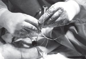Виділення частини пошкодженого сухожилка та введення анкера у горбистість променевої кістки