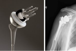 Ендопротезування плечового суглоба – метод оперативного лікування, при якому безнадійно зруйновані структури плечового суглоба замінюються на штучні компоненти