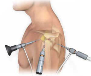 Артроскопія (ендоскопія) - сьогодні, застосовується у всіх провідних клініках світу і вважається «золотим стандартом» лікування травм і захворювань плечового суглоба.