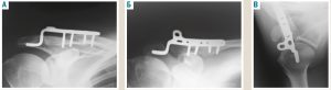Рис. 2. Рентгенографія акроміально-ключичного суглоба (пряма, проєкція 30º та аксіальна) – неправильне розташування Hook-пластини в акроміально-ключичному суглобі.