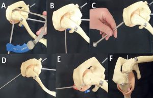 Treatment of acute acromioclavicular joint dislocations type III and type V by Rockwood classification using a dynamic stabilization system under arthroscopic control with and without suture