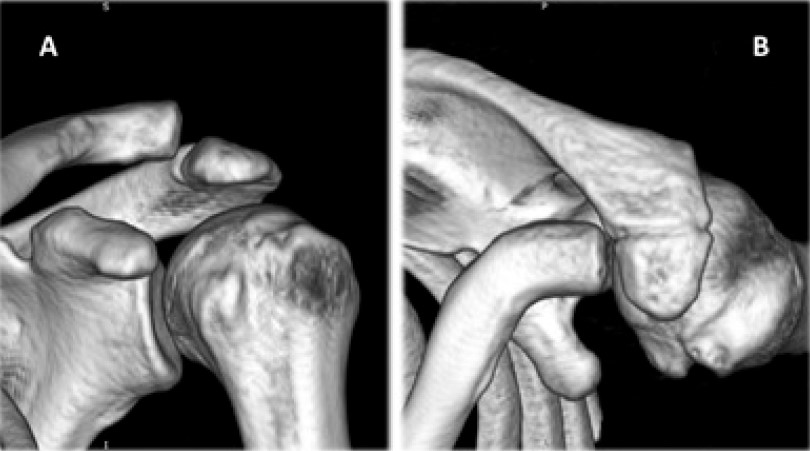 Clinical evaluation and instrumental diagnostics in acute acromioclavicular joint dislocation