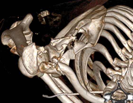 Хибний суглоб тіла та ості правої лопатки з кістковим дефектом, невірно консолідуючий перелом акроміального кінця правої ключиці. Комбінована контрактура правого плечового суглоба.
